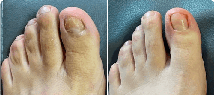 What is Orivelle Nail Fungus Peni – Orivelli
