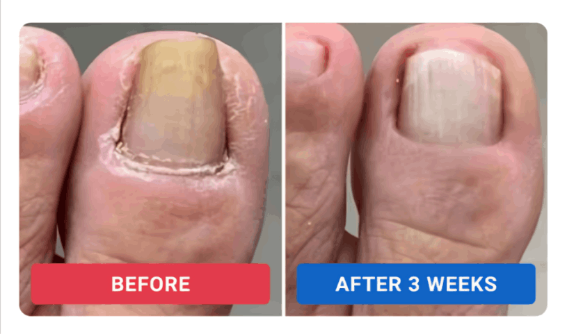 Orivelle Nail Fungus Pen review by Dan R.i – Orivelli