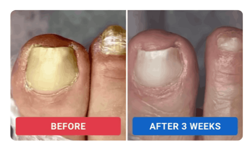 Orivelle Nail Fungus Pen review by Elena S.i – Orivelli