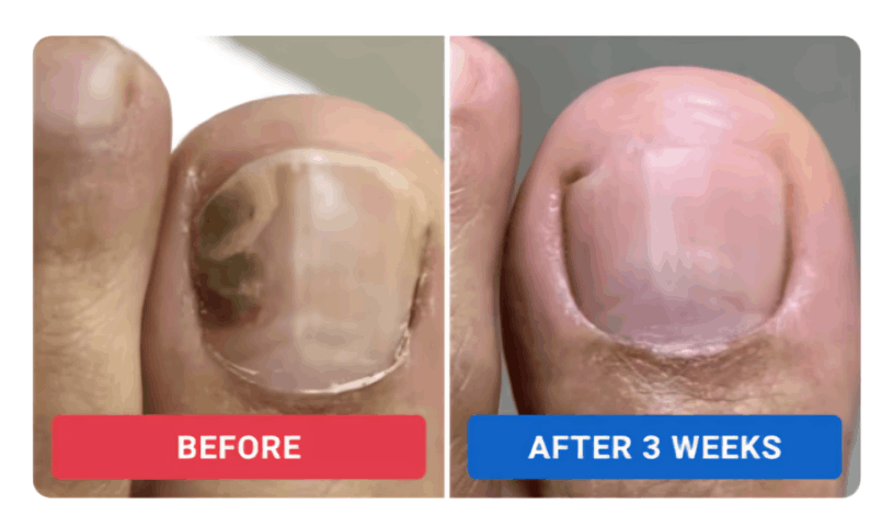 Orivelle Nail Fungus Pen review by Rachel M.i – Orivelli
