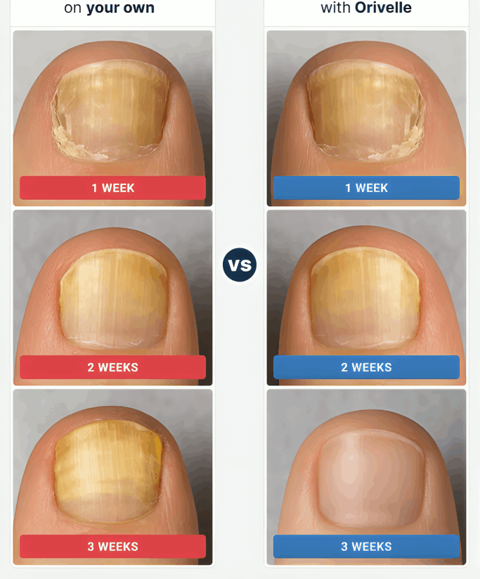 Orivelle Nail Fungus Pen before and afteri – Orivelli